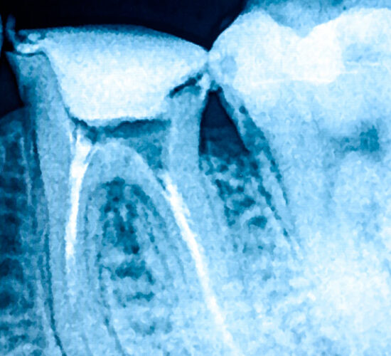 Endodoncista en Terrassa