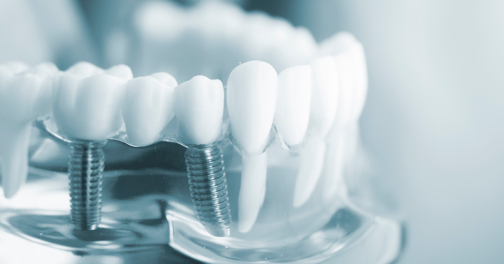 Implantes dentales en Terrassa